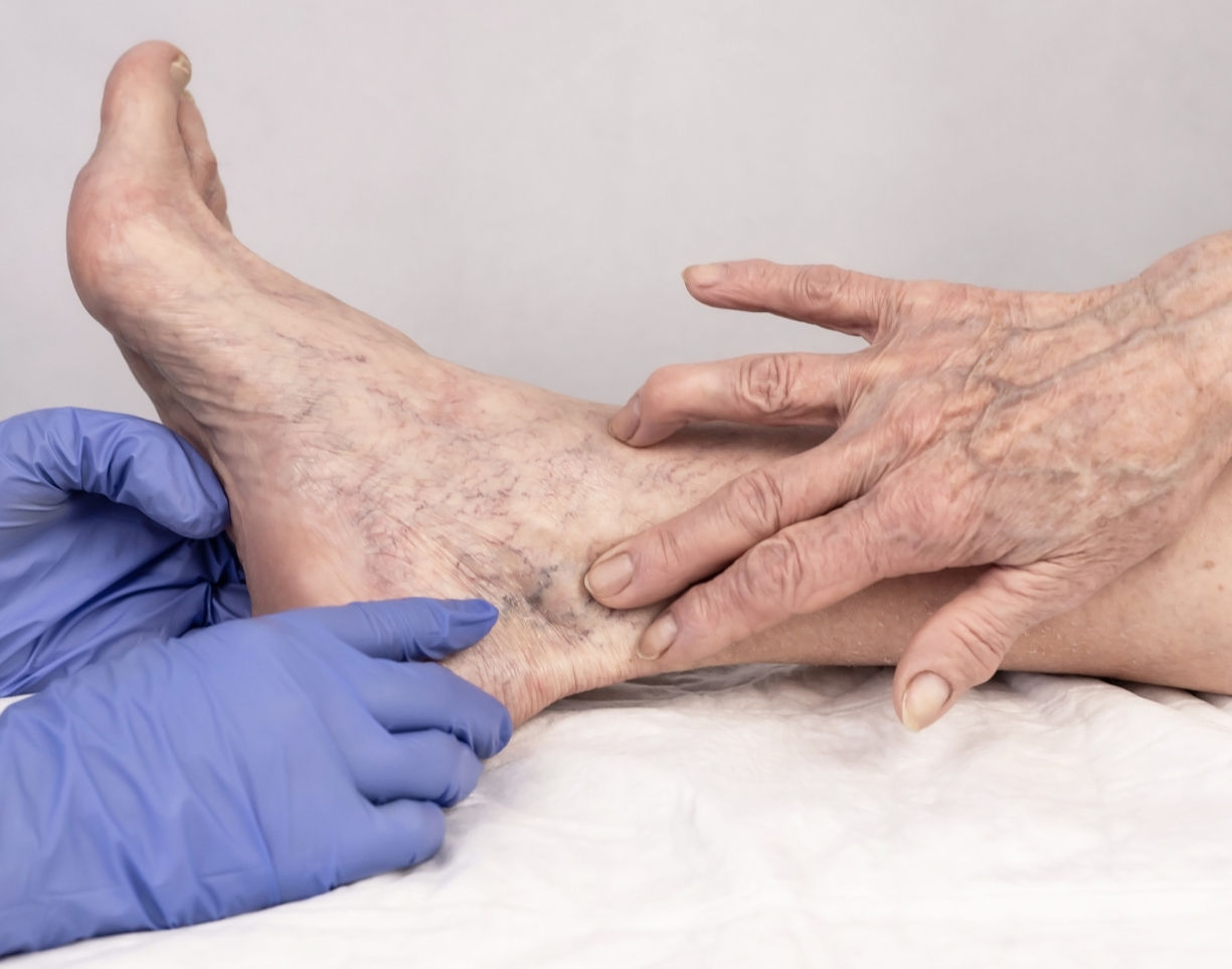 How Do I Know if My Veins Need Medical Treatment – Houston Vein Care