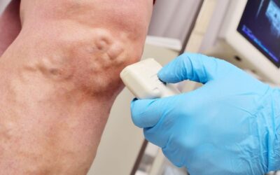 Skin Discoloration and Varicose Veins: Causes, Symptoms, and Treatment Options