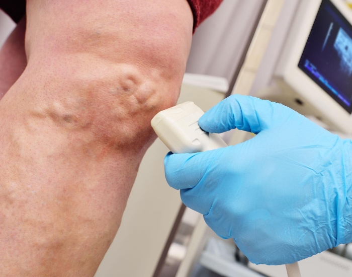 Skin Discoloration and Varicose Veins: Causes, Symptoms, and Treatment Options