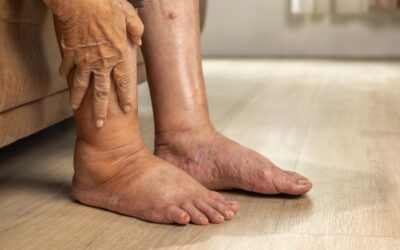 One Leg More Swollen Than the Other: Causes and When to See a Vein Doctor