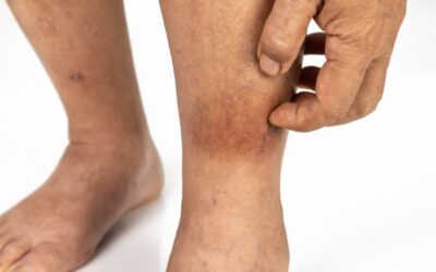 Why Are My Legs So Itchy? Common Causes and When to Be Concerned