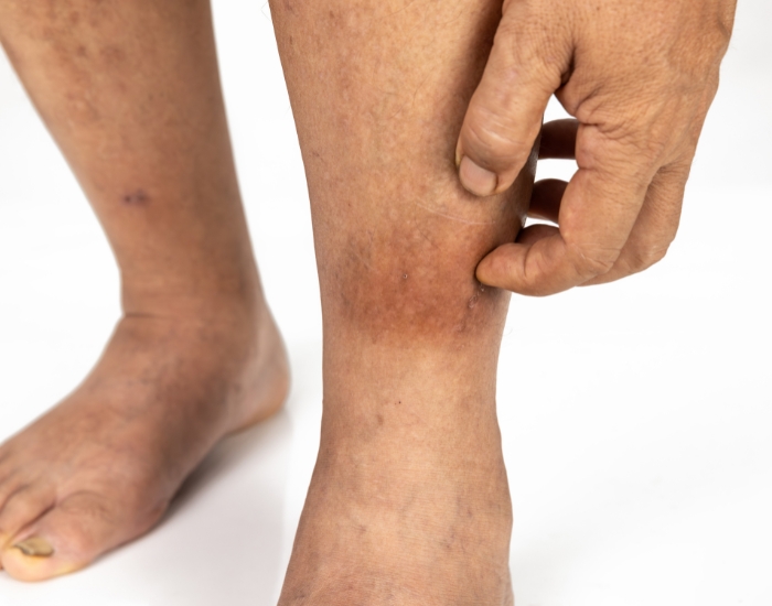 Why Are My Legs So Itchy? Common Causes and When to Be Concerned