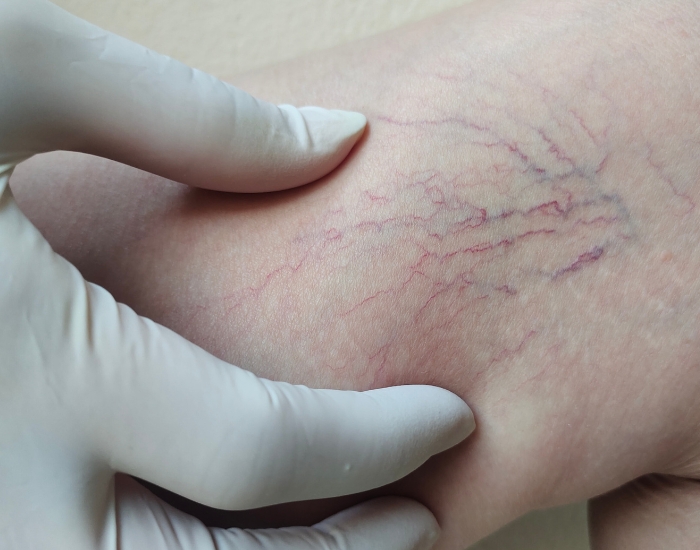 Why Are My Veins So Visible? Causes, Symptoms, and When to Seek Help