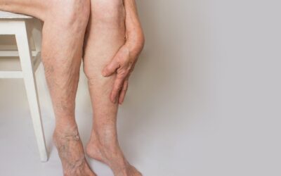 Painful Hard Vein in the Leg: Causes and Treatment