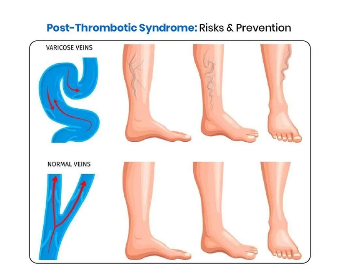 Post-Thrombotic Syndrome: Leg Problems After a Blood Clot