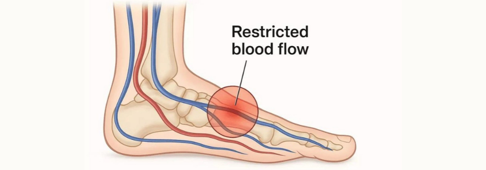 Cold feet as a possible sign of peripheral artery disease